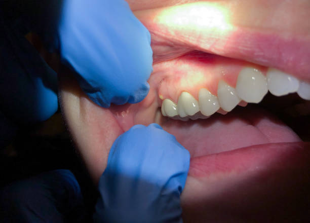 Best Knocked-Out Tooth Emergency  in Chardon, OH
